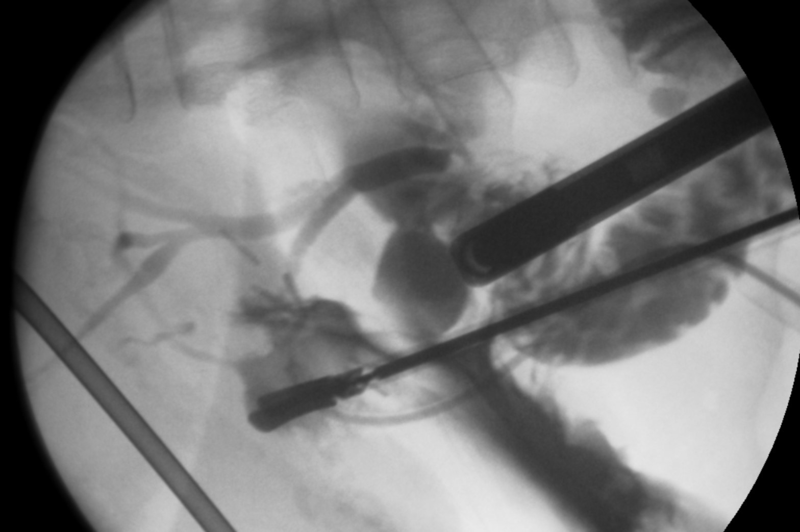 Successful Laparoscopic Cholecystectomy of Double Gallbladder with ...